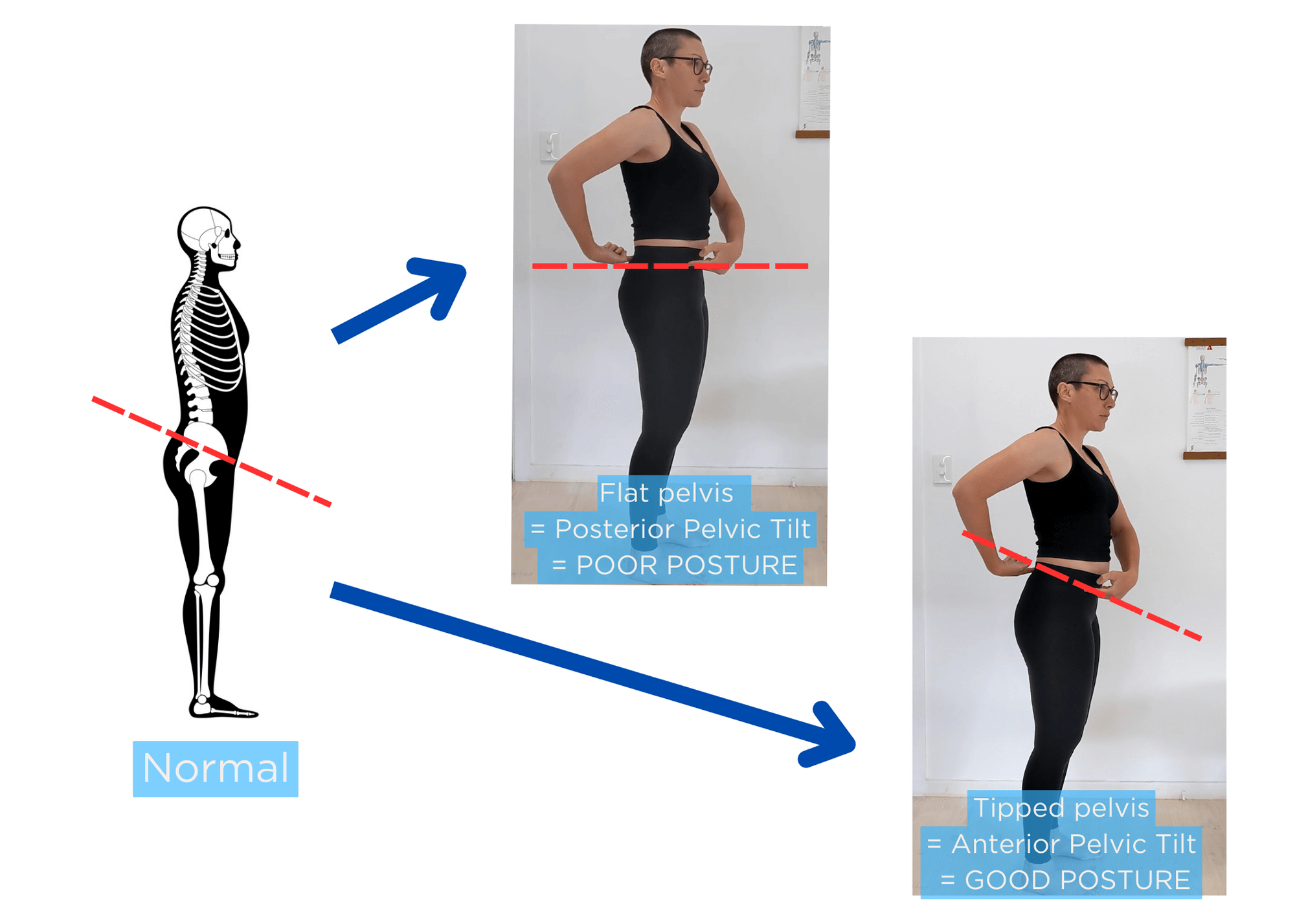 Is Your Anterior Pelvic Tilt Causing You Pain Here s What You Need To Know. Move Mountains Physio